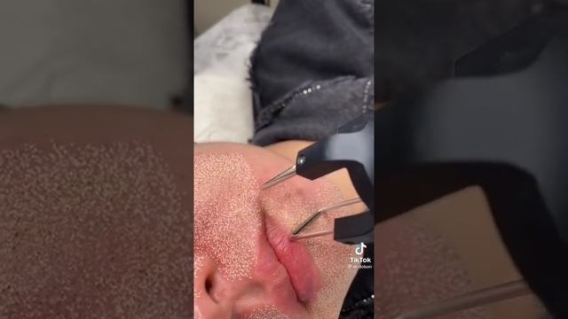 лазерная шлифовка лица смотреть онлайн