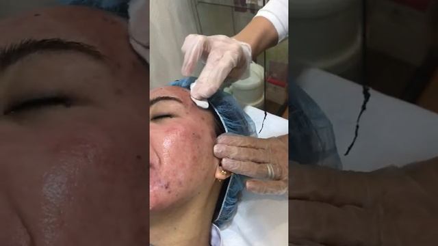 hydra facial procedure.9 смотреть онлайн