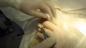 извлечение пули