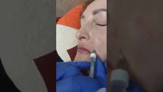 контурная пластика. заполнение носогубных морщин филлером смотреть онлайн