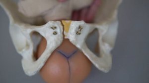 Биомеханизм родов при различных формах сужения таза