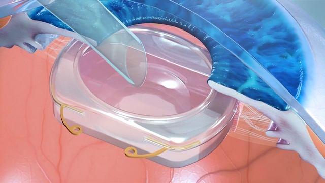 Companies to Watch - Omega Ophthalmics (OIS@AAO 2016) смотреть онлайн