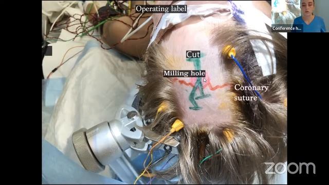 Neurosurgical Case Report (FCN, Tyumen, Russia) смотреть онлайн