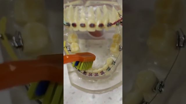 Как правильно чистить зубы с брекет-системой
