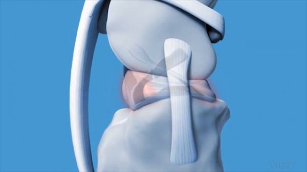 TPLO Animation Video