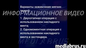 Пошаговая операция по имплантации зубов