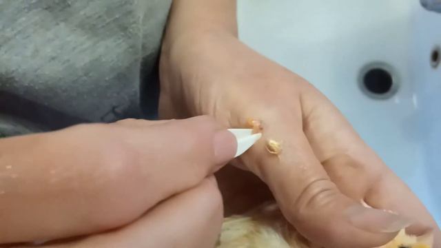 Удаление вросшего пера выкручиванием, часть 2. смотреть онлайн