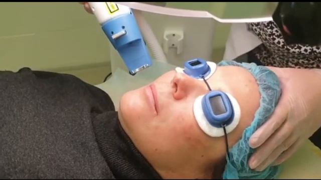 Лазерная эпиляция верхней губы смотреть онлайн