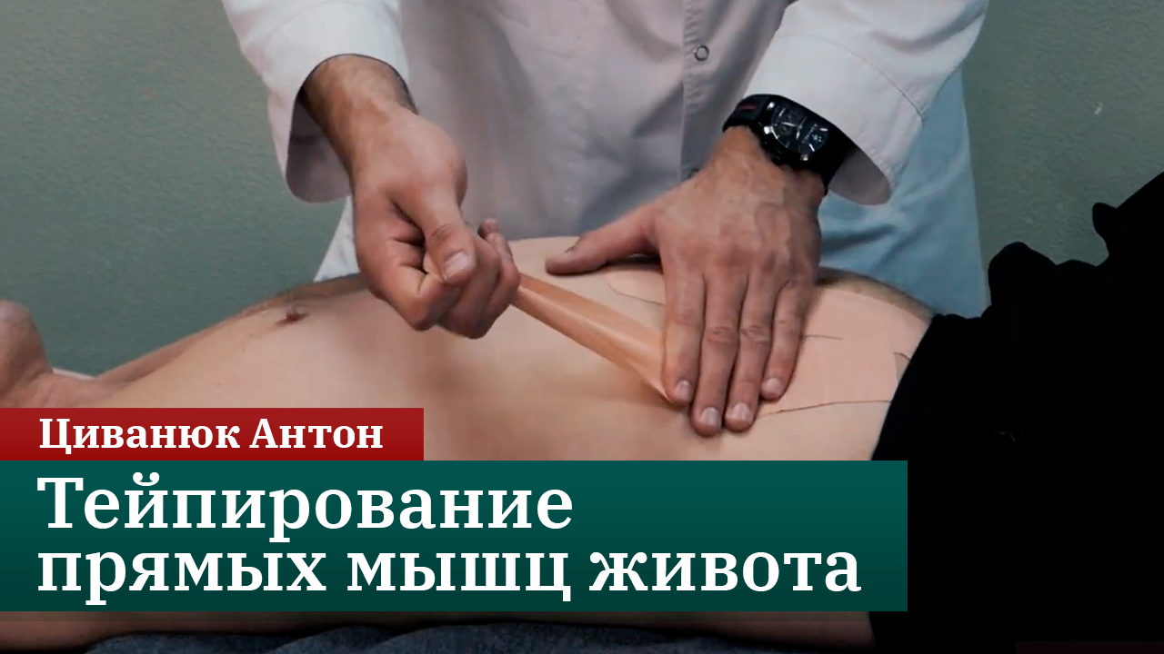 Тейпирование прямых мышц живота. Циванюк Антон смотреть онлайн