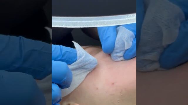Кому потрібна механічна чистка обличчя смотреть онлайн