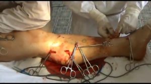 Флебэктомия