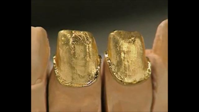 Как изготовить цельнолитую коронку Литая коронка Ортопедическая стоматология смотреть онлайн