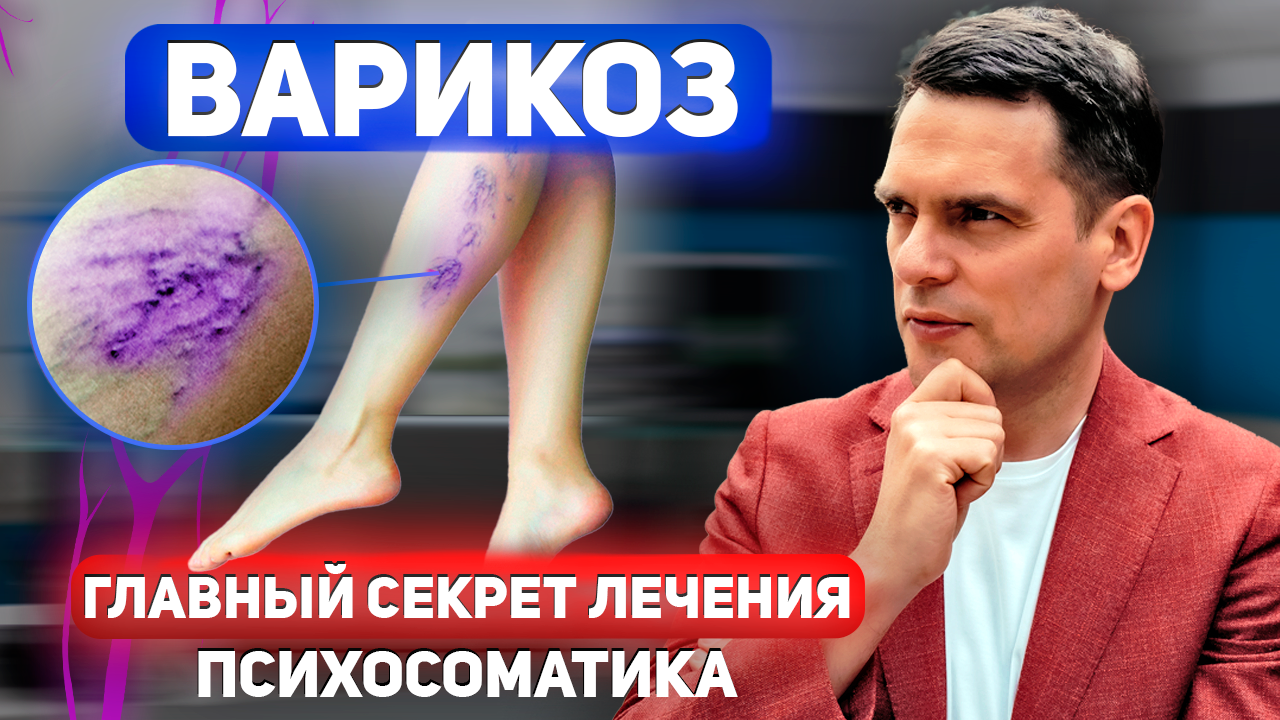 ВАРИКОЗ. САМЫЙ ДЕЙСТВЕННЫЙ СПОСОБ ЛЕЧЕНИЯ смотреть онлайн