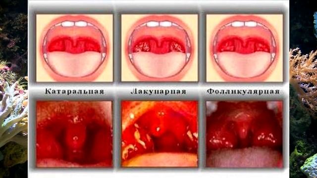 Ангина.Симптомы.Фото.Лечение