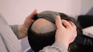 Установка системы волос для мужчины