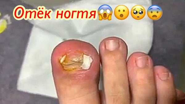 Отёк ногтя???