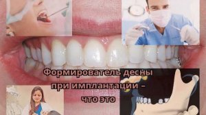 Формирователь десны при имплантации – что это