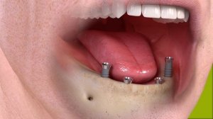 Как устанавливается съемный зубной протез на балке