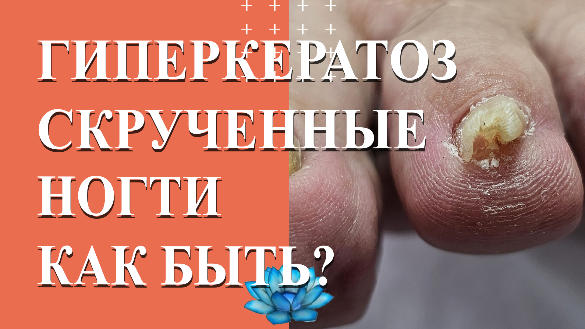 У клиента гиперкератоз ногтей. Аппаратный педикюр на скрученные ногти. смотреть онлайн