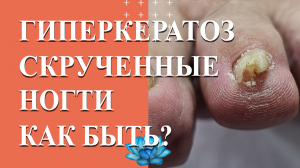 У клиента гиперкератоз ногтей. Аппаратный педикюр на скрученные ногти.