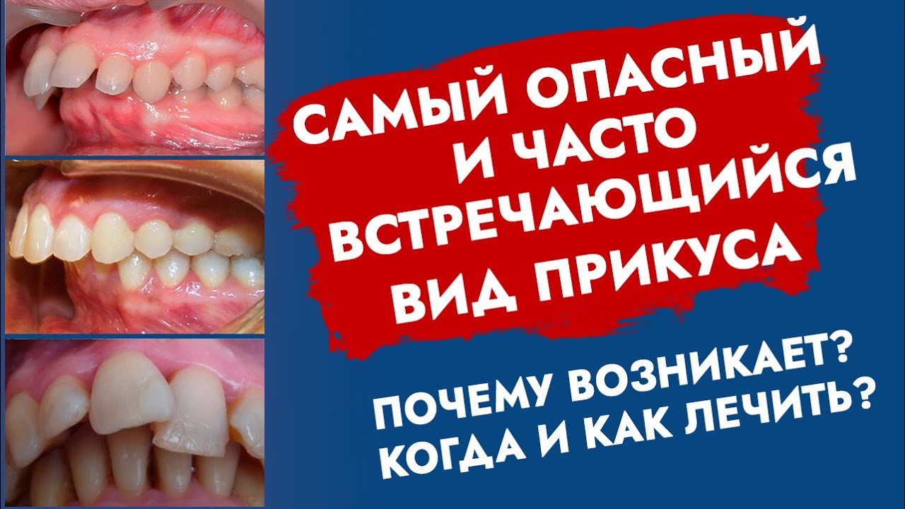 Дистальный прикус. Прогнатия. 2 класс по Э. Энглю. Неправильный прикус. смотреть онлайн