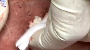 Relax squeezing out blackheads #31 Черные точки