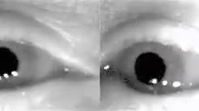 BPPV Nystagmus смотреть онлайн