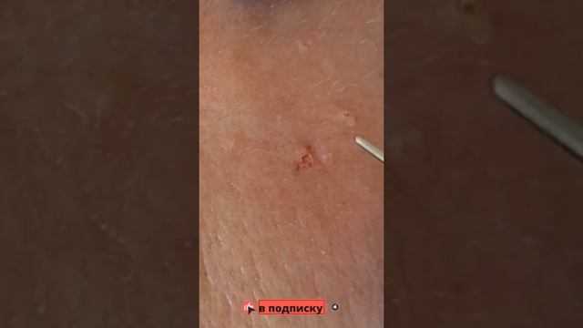 Милиум удаление/лечение просянки/удаление кисты сальной железы смотреть онлайн
