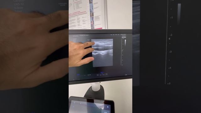 Идеальные сосуды. Узи сонных артерий. Сосудистый хирург. Флеболог Москва. Флеболог смотреть онлайн