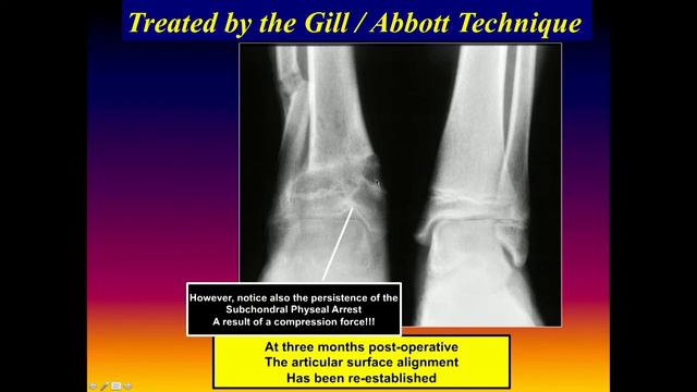 Fractures In The Region Of The Ankle In The Pediatric Patient смотреть онлайн