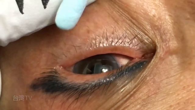 Distichiasis. смотреть онлайн