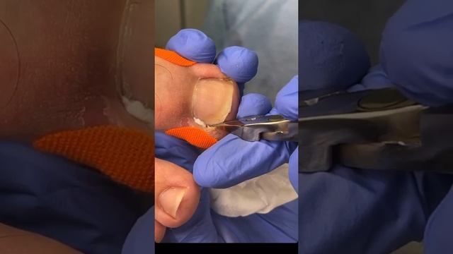 Вросший ноготь???