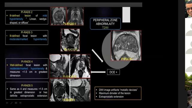 Prostate cancer PI RADS V2 смотреть онлайн
