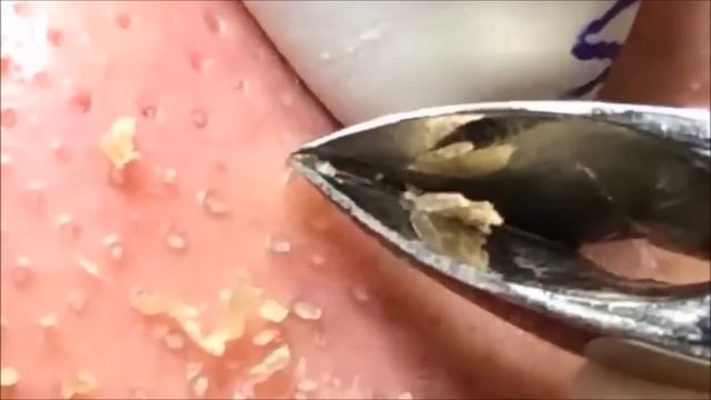 角栓　除去　blackheads　removal #093