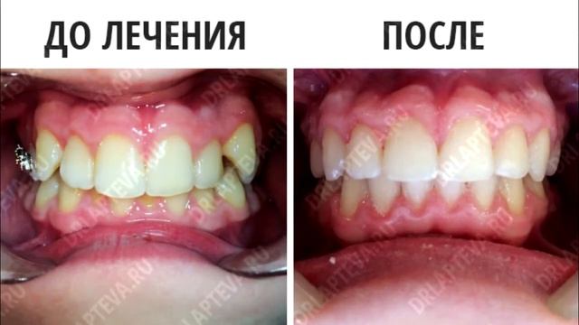 Сколько времени носить брекеты? Отзывы. смотреть онлайн