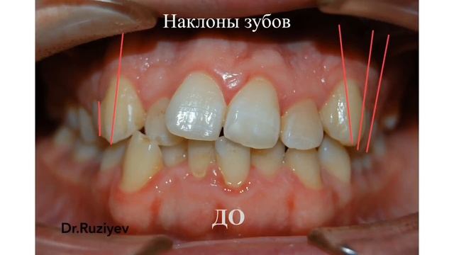 Без брекетов, пациента теперь не узнать смотреть онлайн