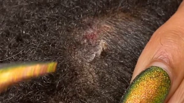 SCRATCHING TOUGH FLAKES | HUGE SCALE REMOVAL | ITCHY SCALP