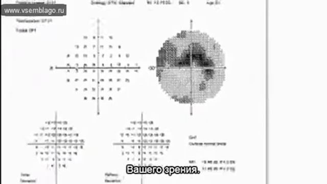 Диагностика глаукомы смотреть онлайн