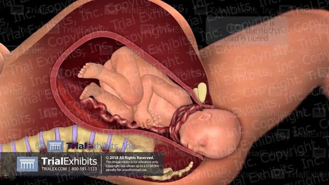 Delivery with Nuchal Cord смотреть онлайн