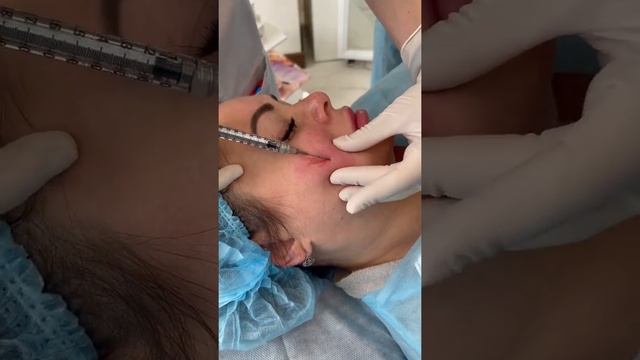 Trueself Poly-L-Lactic Acid (PLLA) filler 400 face injection for nonsurgical face rejuvenation смотреть онлайн