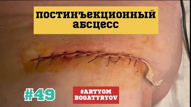 49. Ушивание дефекта