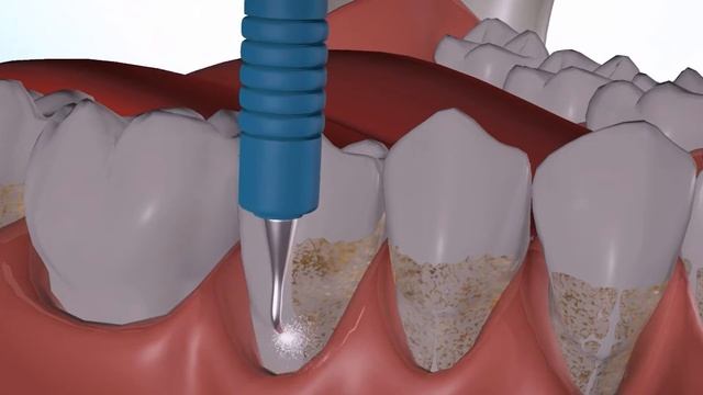 Get a Clean And Healthy Smile with an Ultrasonic Teeth Cleaning | The Dental District смотреть онлайн