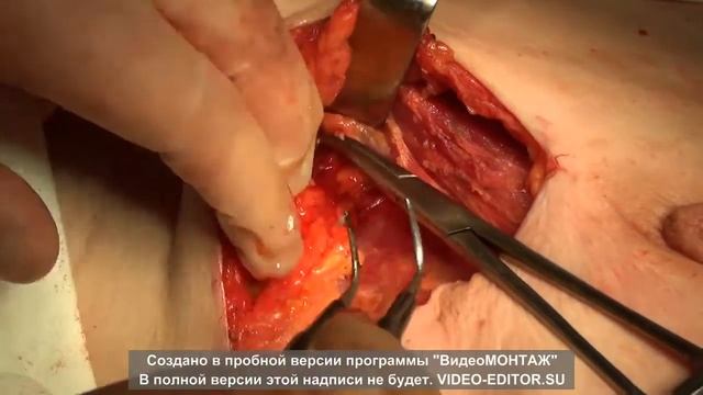 Видео подкожная мастэктомия по Маддену с установкой экспандера смотреть онлайн
