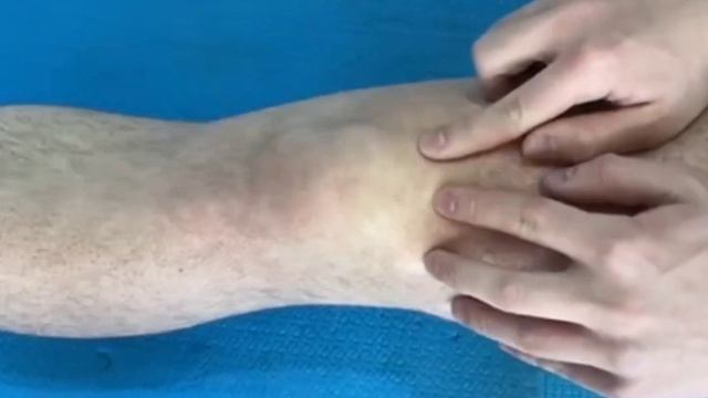 Упражнения для реабилитации после травмы крестообразной связки колена