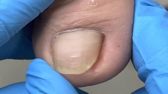 Inwardly Rolled Toenails Have Been Deteriorating For A Long Time【Xue Yidao Pedicure】