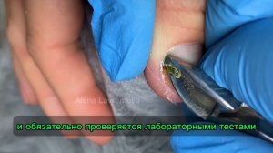 Синегнойная палочка / Зеленый ноготь что это? Что с ногтем? Что делать если ноготь позеленел