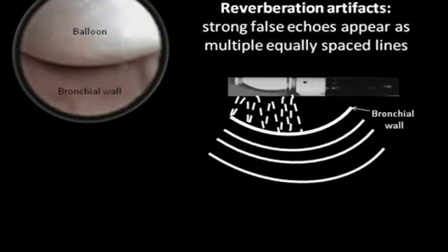EBUS Physics Video - Endobronchial Ultrasound смотреть онлайн