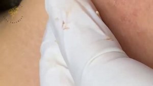 камедоны , угри лицо