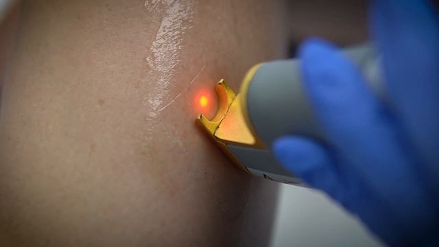 What To Expect - Excel V Laser Vein Treatment | Instantly Remove Spider Veins! смотреть онлайн