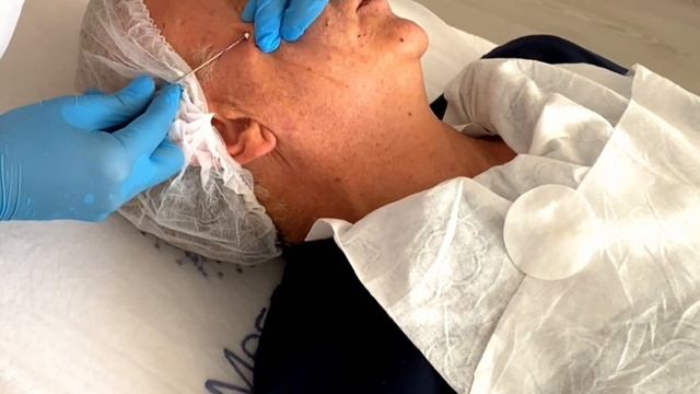 Нитевой лифтинг нитями Cog смотреть онлайн